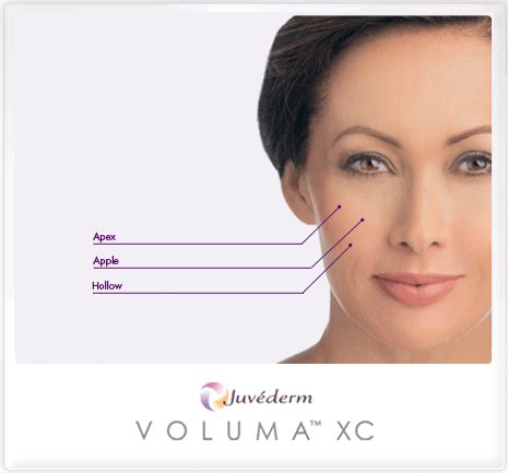 juvederm voluma filler expert  jacksonville ponte