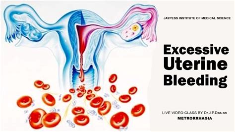 Excessive Uterine Bleeding Jaypess Institute Of Medical Science