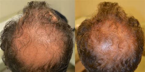 Finasteride Before And After Pictures Plushcare