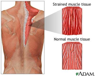 muscle strain medlineplus medical encyclopedia image