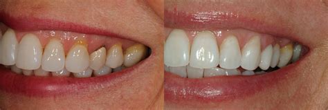 dental crown jupiter fl restorations dental crowns