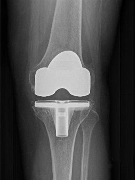 knee replacement 8 buyxraysonline