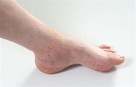 common    swollen ankle