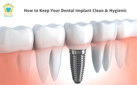 dental implants clean hygienic elite dental care