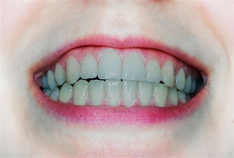 gray teeth  treatment  care complications