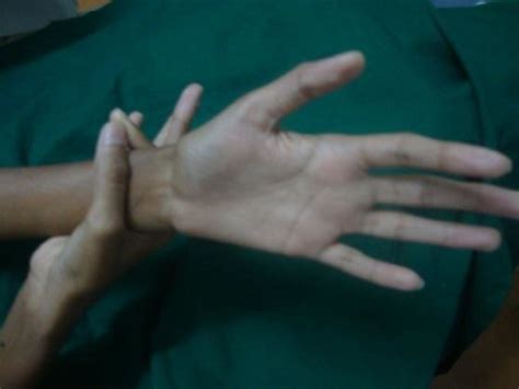 photograph showing wrist sign walker sign positive
