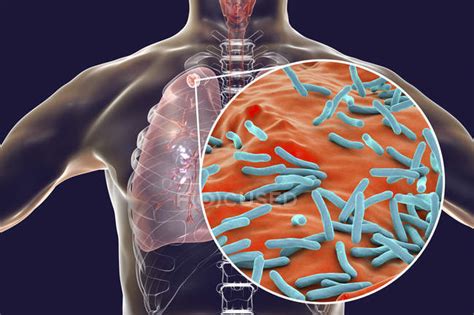 secondary tuberculosis lungs infection  close   mycobacterium