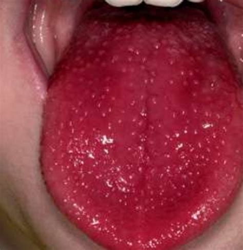 Your Tongue Can Reveal Surprising Things About Your Health Daily Digest