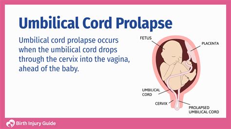 umbilical cord prolapse birth injury guide hot sex picture