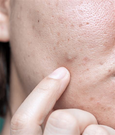 acne treatments winter park fl revive skincare clinic
