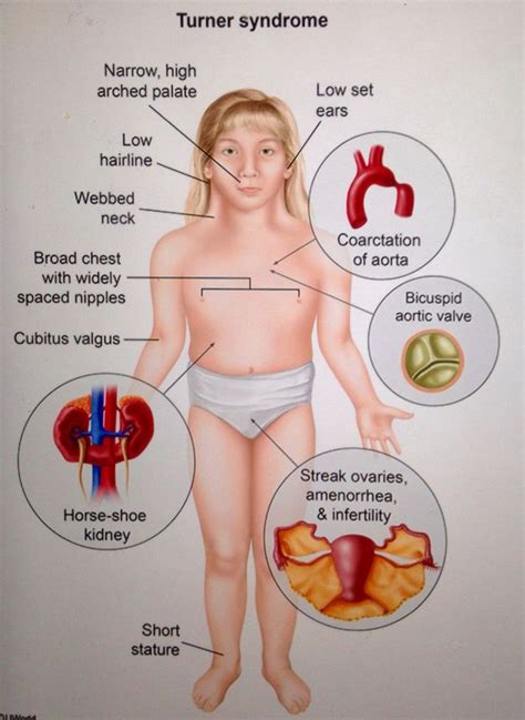 Turner S Syndrome Cardiac Manifestations Include