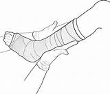 Cast Leg Clipart Arm Drawing Cliparts Clip Library sketch template