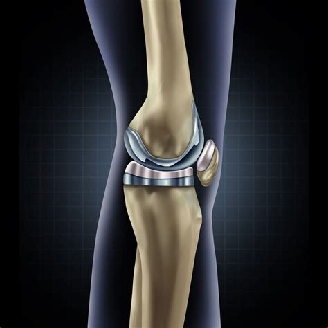 knee replacement     lifetime