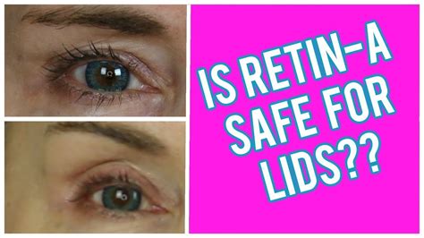 how to use retin a for hooded eyelids how i apply it ask your