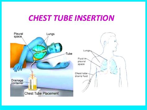 chest tube insertion  monitoring nurses note