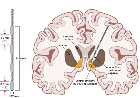 frontiers deep brain stimulation  obsessivecompulsive disorder  long term naturalistic
