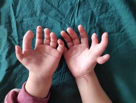 girl born with too many fingers has extra digits surgically removed