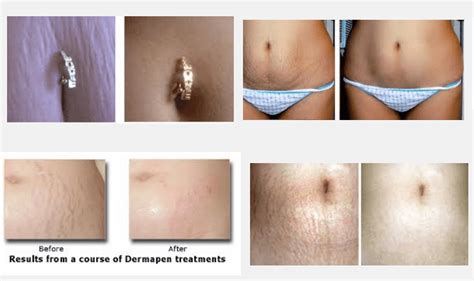 laser stretch mark removal the advanced way of removing