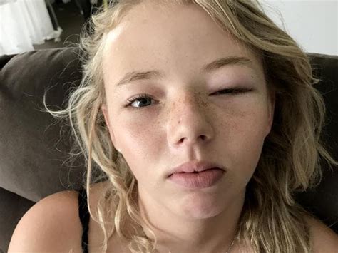 Kmart Eye Mask ‘blinds Teen’ With Allergic Reaction Adelaide Now