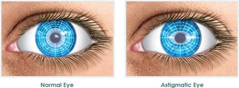 laser eye surgery  astigmatism accuvision eye clinic