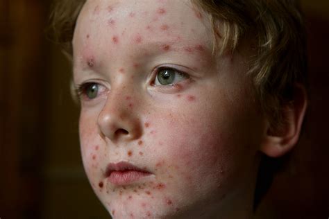 Why “chickenpox Parties” Are A Terrible Idea—in Case It’s Not Obvious
