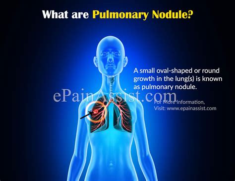 pulmonary nodulecausessymptomstreatmentdiagnosis