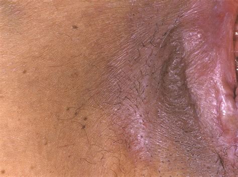 emerging treatments for vulvar lichen sclerosus offer