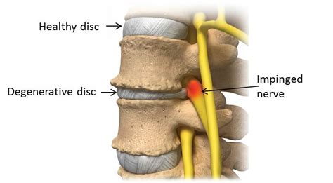 degenerative disc disease    pain