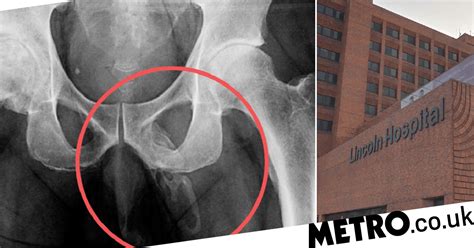 Mans Penis Is Slowly Turning Into Bone Due To Rare Condition Metro News