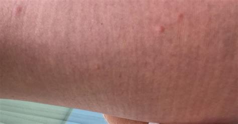 Red Itchy Bumps On Legs