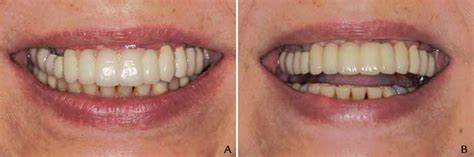 Management Of Patients With Excessive Gingival Display For Maxillary