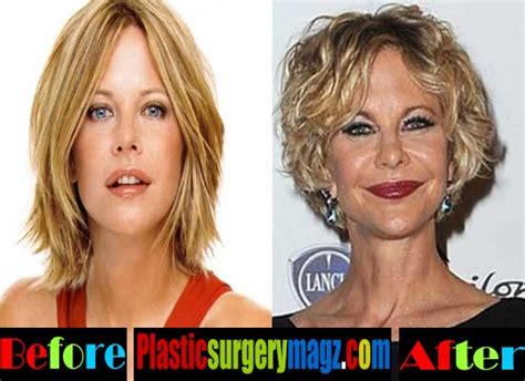 Meg Ryan Plastic Surgery Disaster Plastic Surgery Magazine