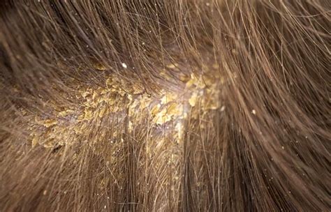 Is it Dandruff or Dry Scalp? How to Cure Both! | The