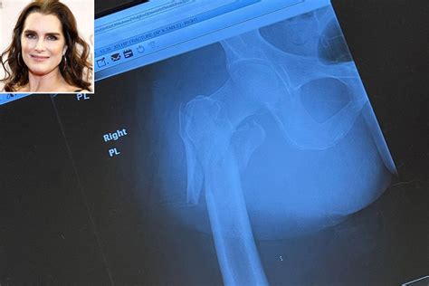 brooke shields shares x ray of her broken femur