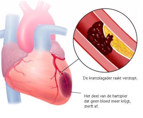 wat  het verschil tussen een hartinfarct en een hartaanval med nl