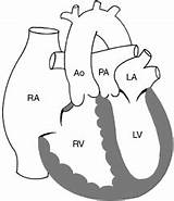 Transposition Arteries Great Complete Diagram Ventricle Left Right Aorta 47c Ao Lv Rv Showing Figure sketch template