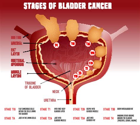 What Is The Cause Of Bladder Cancer Updated