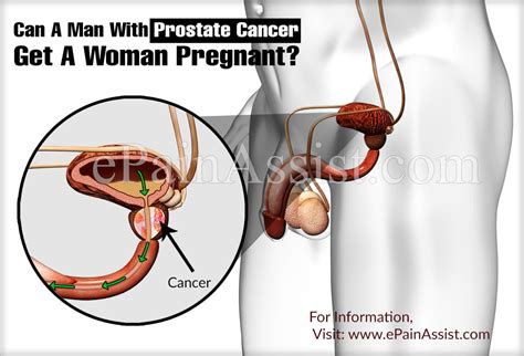 Can A Man With Prostate Cancer Get A Woman Pregnant
