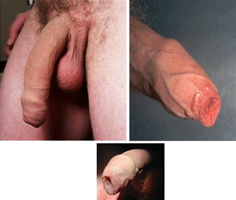 un circumcised penis best naked ladies