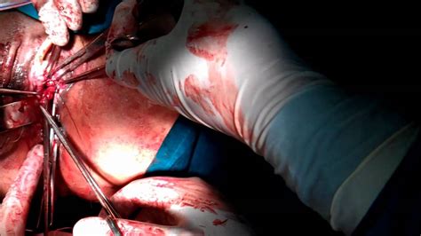 vaginal vesicovaginal fistula repair part 2 by prof hazem sammour youtube