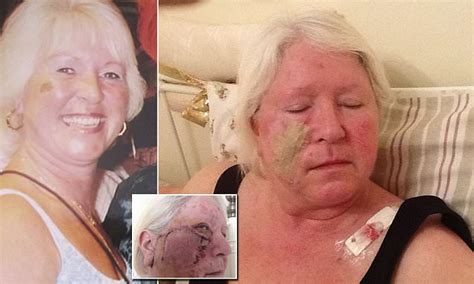 kent sunbed addict left with hole in face from skin cancer