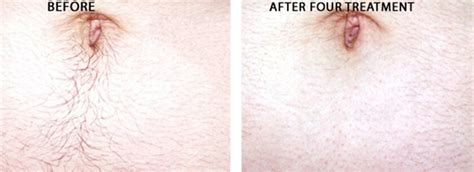 laser hair removal before and after photos nyc