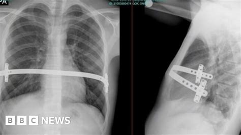 pioneering chest deformity op carried out at cardiff hospital bbc news