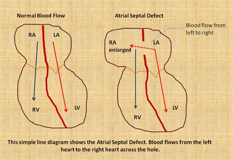 atrial septal defect asd heart sense
