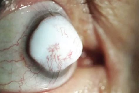 grim  show giant white lump growing  mans eyeball  cataract op