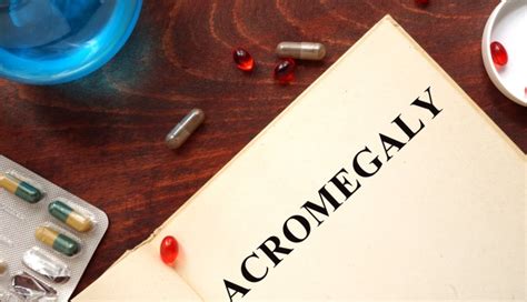 updated consensus on management of acromegaly includes new