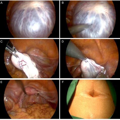 a large ovarian cyst ≥10 cm in diameter b aspiration of cystic