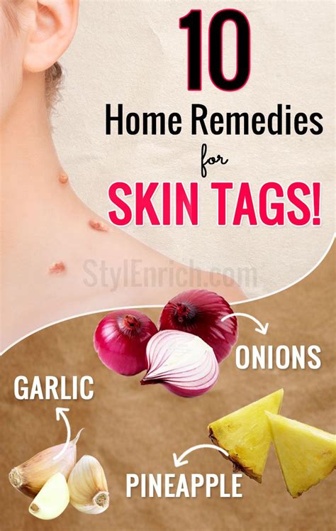 home remedies for skin tags that you must know