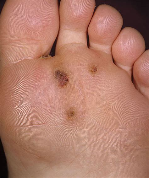 brown freckle like spots on feet and ankles