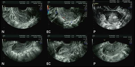 Frontiers Automatic Measurement Of Endometrial Thickness From